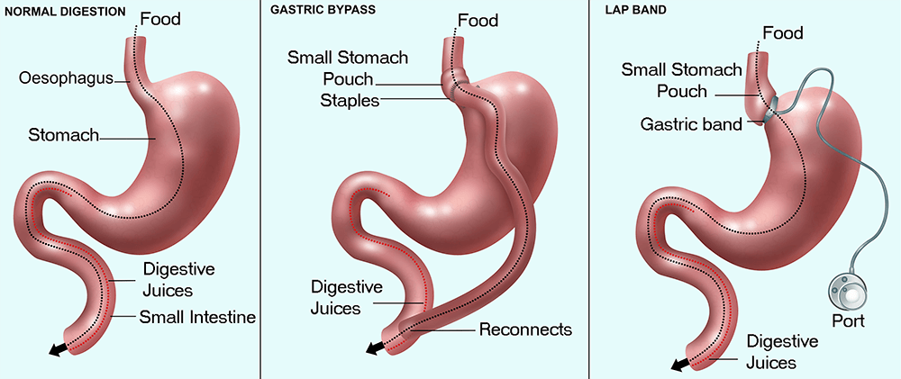Retatrutide after bariatric surgery weight regain GLP-1 research gastric sleeve bypass 2026