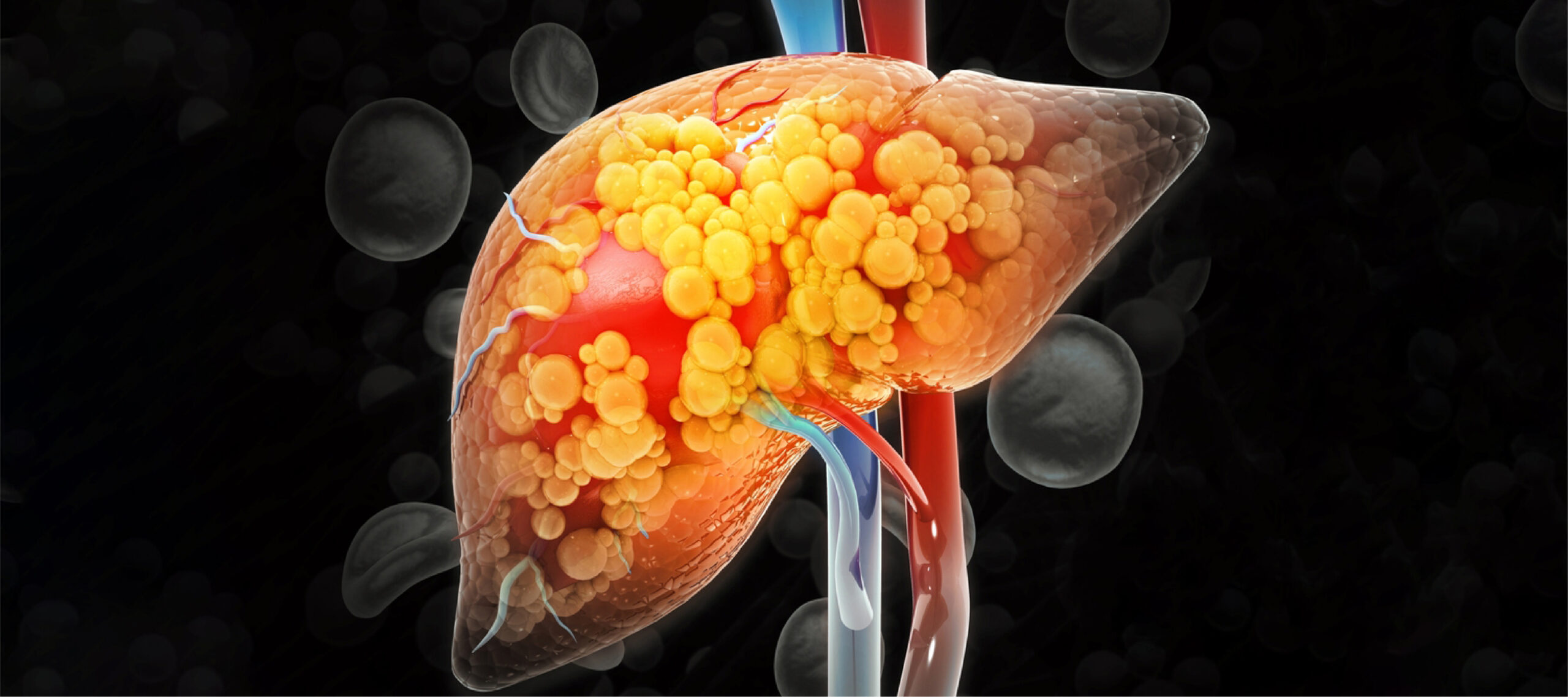 Retatrutide and fatty liver MASLD MASH liver fat reduction Phase 2 clinical data 2026