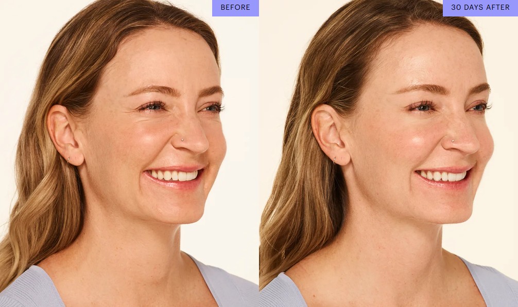 Botox after significant weight loss Ozempic face facial volume loss GLP-1 aesthetic treatment 2026